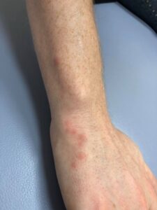 画像で見る ツメダニ 気になる虫さされ症状と特徴の違いをチェック 寝室のダニさんキラー